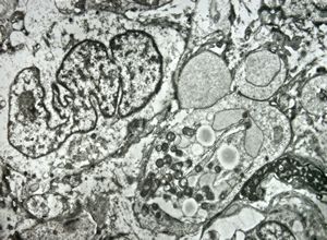 F,12y. | malignant tumor of the orbita - liposarcoma?, neurofibrosarcoma?